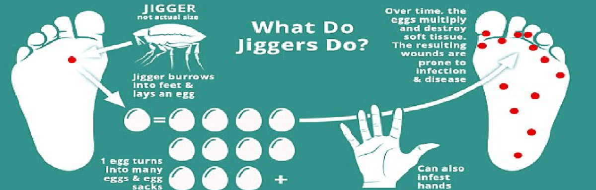 Jiggers infestation control & management Kenya