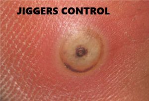 jiggers control in Nairobi Kenya