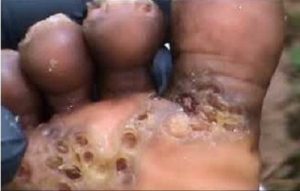 jiggers control in Nairobi Kenya