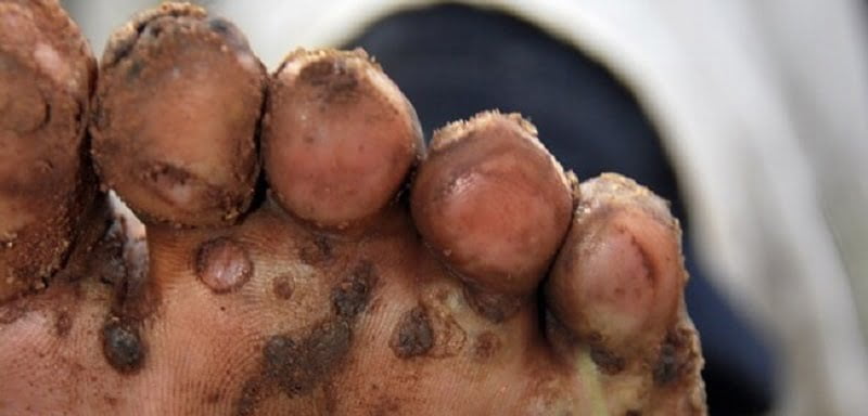 jiggers infestation control in Kenya