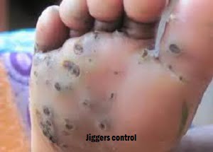 Jiggers Infestation Control in Kenya Jiggers Infestation Control in Kenya