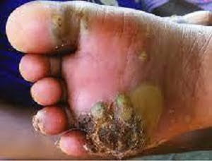 Jiggers control in Kenya Jiggers control in Kenya