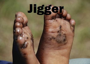Jiggers infestation control in Nairobi Jiggers infestation control in Nairobi